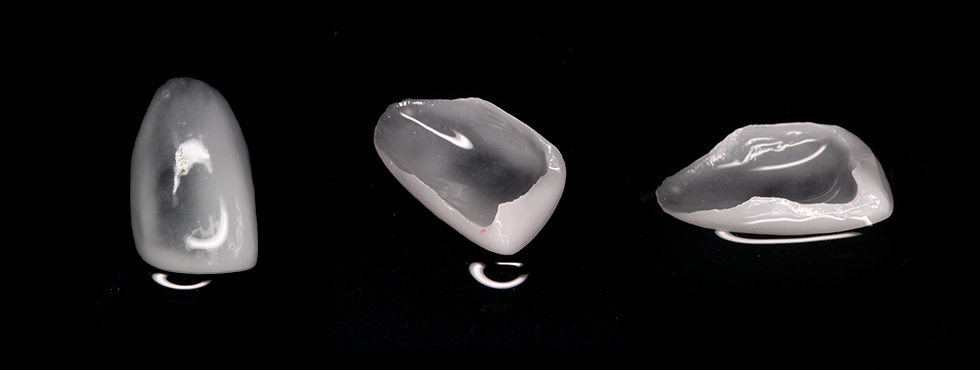 하루최대45개만치아제작