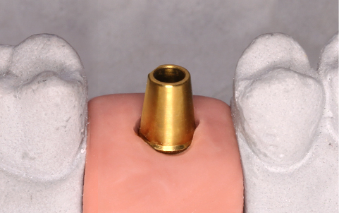 MINISH牙科|MINISH种植牙|MINISH种植牙价格|MINISH全瓷牙修复|MINISH牙科医院|MINISH牙齿贴面|韩国牙科医院|韩国牙齿整形医院|韩国牙齿美容医院|韩国牙科整形价格 기성 어버트먼트