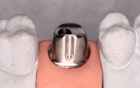 MINISH牙科|MINISH种植牙|MINISH种植牙价格|MINISH全瓷牙修复|MINISH牙科医院|MINISH牙齿贴面|韩国牙科医院|韩国牙齿整形医院|韩国牙齿美容医院|韩国牙科整形价格 맞춤 어버트먼트