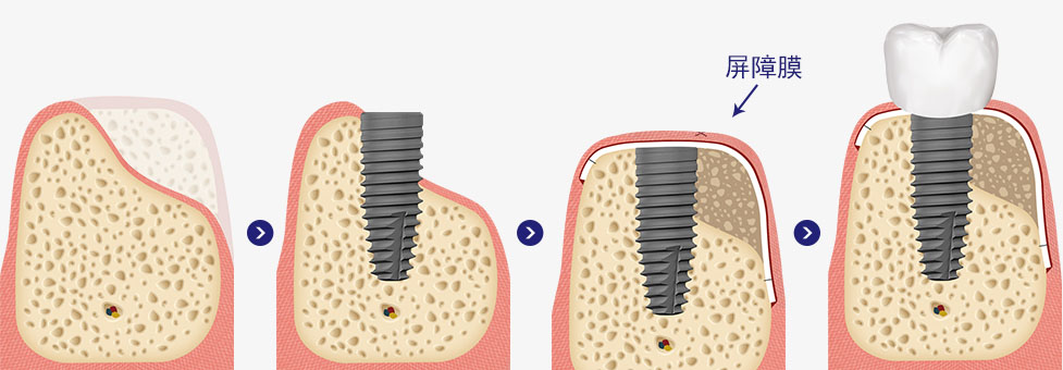 MINISH牙科|MINISH种植牙|MINISH种植牙价格|MINISH全瓷牙修复|MINISH牙科医院|MINISH牙齿贴面|韩国牙科医院|韩国牙齿整形医院|韩国牙齿美容医院|韩国牙科整形价格 골유도 재생술