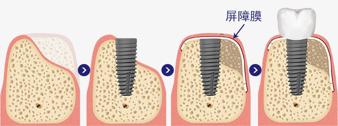 MINISH牙科|MINISH种植牙|MINISH种植牙价格|MINISH全瓷牙修复|MINISH牙科医院|MINISH牙齿贴面|韩国牙科医院|韩国牙齿整形医院|韩国牙齿美容医院|韩国牙科整形价格 골유도 재생술