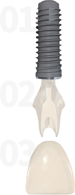 MINISH牙科|MINISH种植牙|MINISH种植牙价格|MINISH全瓷牙修复|MINISH牙科医院|MINISH牙齿贴面|韩国牙科医院|韩国牙齿整形医院|韩国牙齿美容医院|韩国牙科整形价格 임플란트