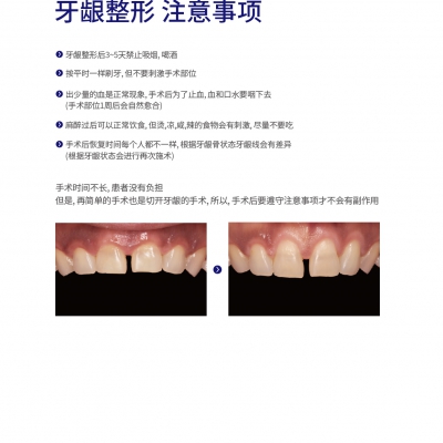牙龈整形注意事项