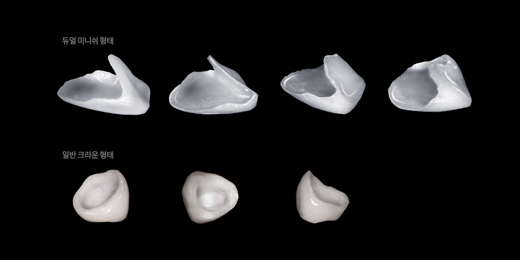 MINISH牙科|MINISH种植牙|MINISH种植牙价格|MINISH全瓷牙修复|MINISH牙科医院|MINISH牙齿贴面|韩国牙科医院|韩国牙齿整形医院|韩国牙齿美容医院|韩国牙科整形价格